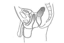 陰茎陰嚢皮膚反転法による腟形成（図）