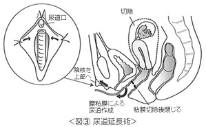 尿道延長術（図）